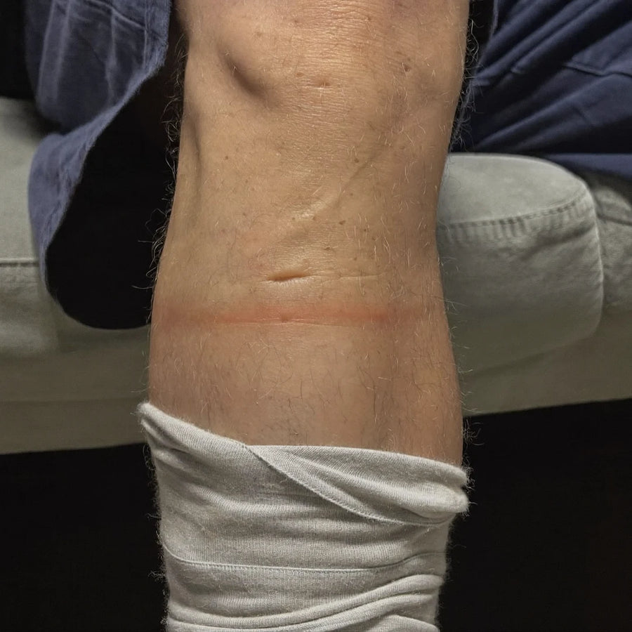La trace de l'élastique sur le mollet en fin de journée